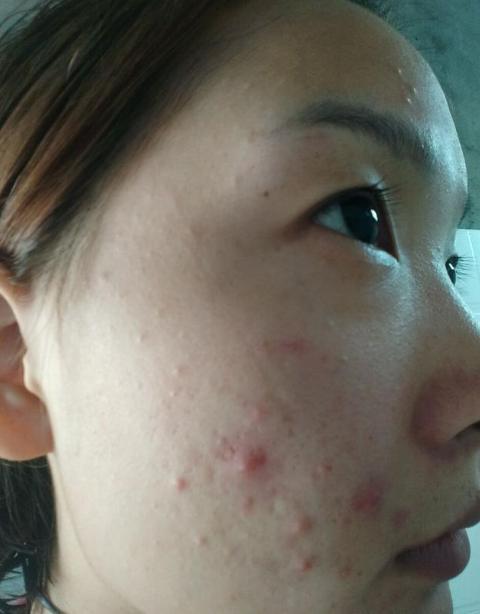 知道痘痘位置,了解原因才更好帮你祛痘