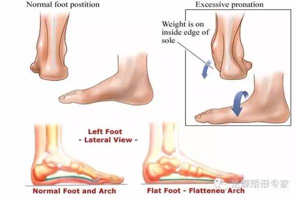 精华篇 关于扁平足 一文读懂怎样预防或治疗最有效 健康频道 手机搜狐
