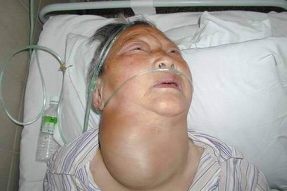 地方性甲状腺肿的艾灸治疗方法