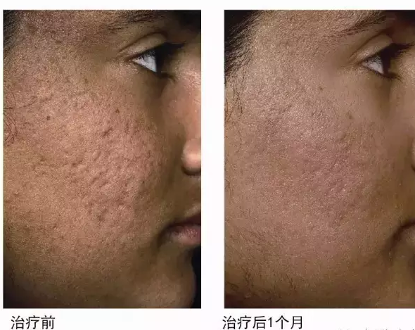 sellas光纤1550点阵激光去皱仪:1550nm技术除皱