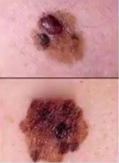 这种痣容易癌变!| 谢霆锋因早发现完胜皮肤癌