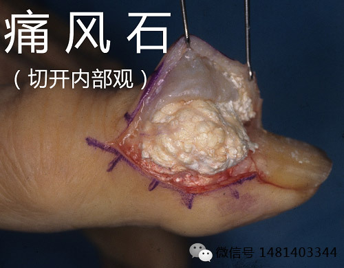 3 痛风石是否应该手术?