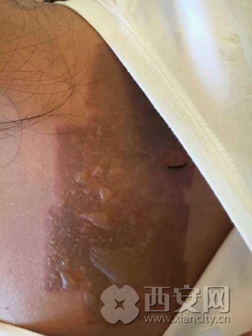 因为晒黑做光疗结果背部变成二度烧伤 组图 新闻频道 手机搜狐