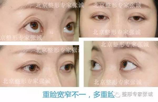 各种失败双眼皮的症状表现 修复方法及最佳时间 健康频道 手机搜狐