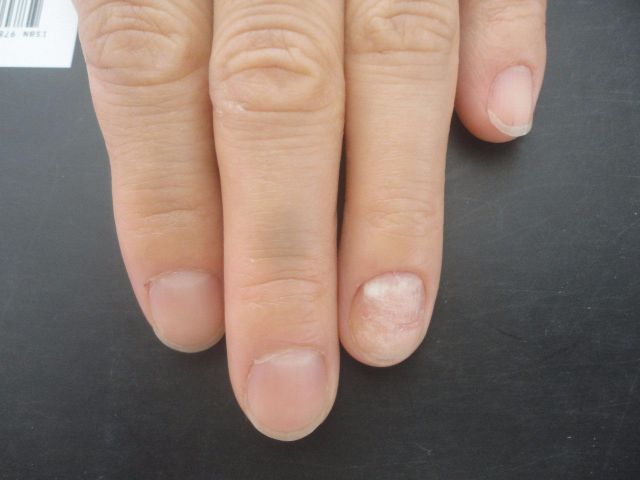 抽空花几秒看看自己的指甲,有这种纹路的就要当心了!