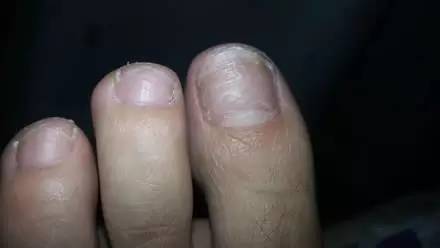 3,甲板混浊:病甲毫无光泽,初期一般呈污灰色,白色.