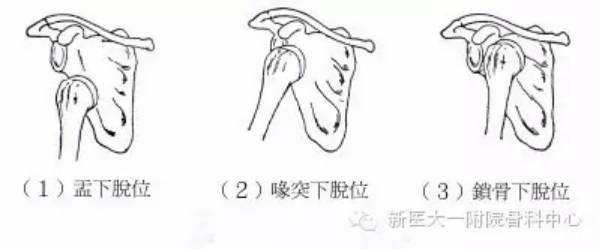 欲哭无泪的美国看病经历 读后感 再谈肩关节脱臼 健康频道 手机搜狐