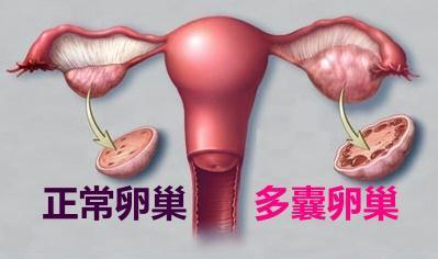 女性脱发 痤疮 多毛 与多囊卵巢 健康频道 手机搜狐