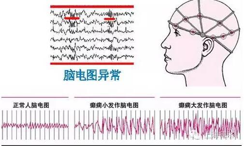 脑电图检查 癫痫诊断必备 助手 你选对了吗 健康频道 手机搜狐