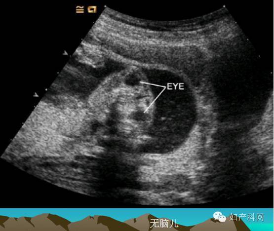 胎儿胸裂图片
