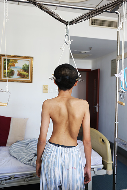 家长这样做可发现孩子脊柱侧弯,五种情况需手术