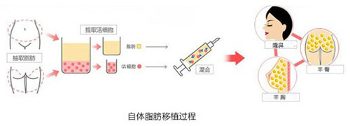 注射隆鼻 你选择自体脂肪还是玻尿酸 俏美网 健康频道 手机搜狐