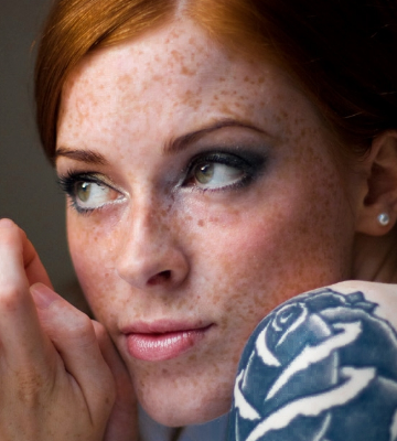 脸上的黄褐斑可以治疗吗怎么去掉?