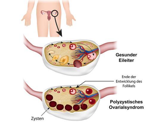 子宫肌瘤患病率高达20%!到底是切还是留?