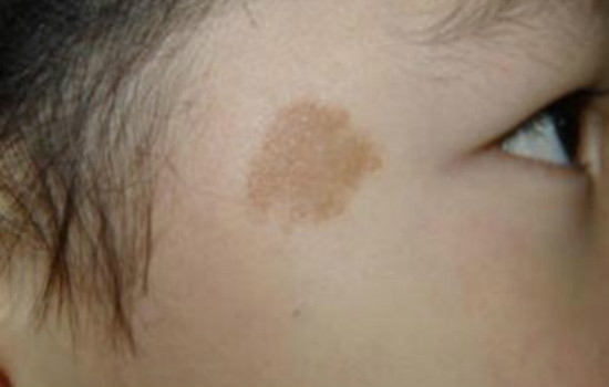 斑的种类及图片看图教你正确认识脸上斑种 健康频道 手机搜狐