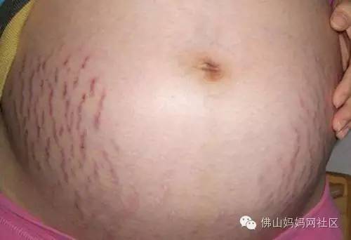 世界这么大 消除妊娠纹总有方法的 母婴频道 手机搜狐