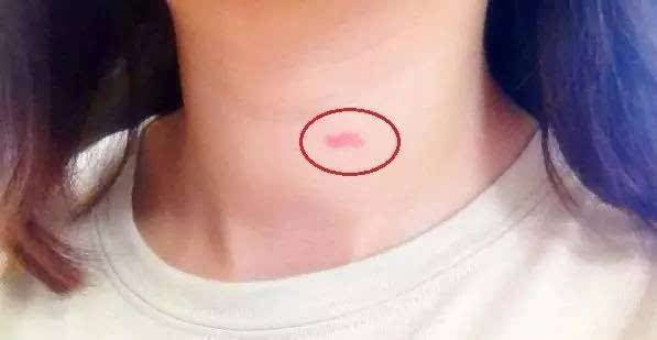 吻痕,是指唇的印记,学名称为"机械性紫斑",主要成因是皮下微血管在