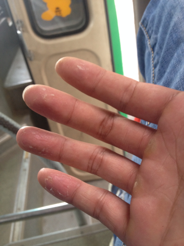 手脱皮是因为缺少维生素吗?