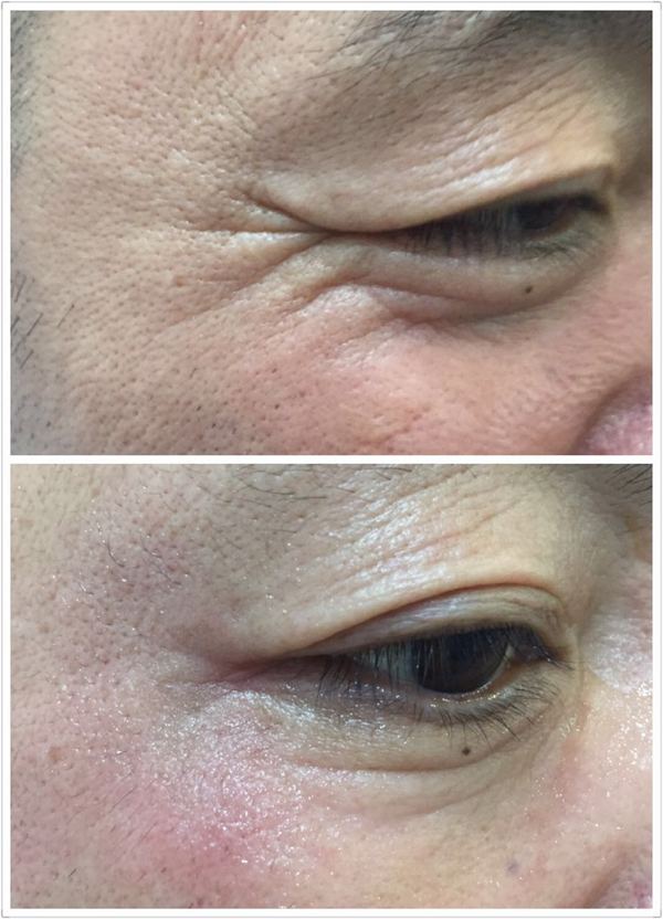 激光去皱王 185/2009/7738(可加微信) 2大领先科技,开启无针祛皱时代