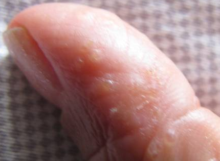 湿疹 水疱 手 手湿疹が治らない原因と考えられる病気〜手湿疹の治療とは〜