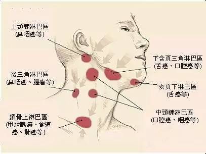 淋巴结肿大不一定是瘤 但是要小心无痛肿块 健康频道 手机搜狐 淋巴结肿大不一定是瘤 但是要小心无痛肿块 健康频道 手机搜狐