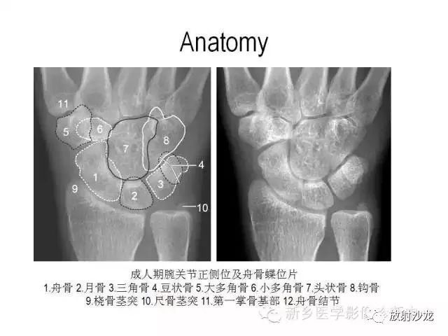 详细的腕关节x线解剖 摄影技巧 阅片技巧 测量 旅游频道 手机搜狐