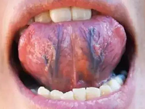 舌头底下有淤血点图片图片