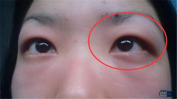 第三个信号:早上起床的时候,出现脸部浮肿,甚至四肢肿胀 包括眼脸浮肿