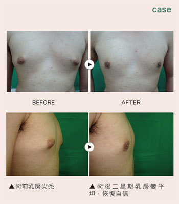 女乳症 海咪咪男 健康频道 手机搜狐