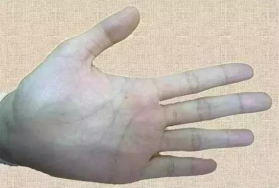 成人手指青筋,不但提示消化系统有问题,还反映了头部血管微循环障碍