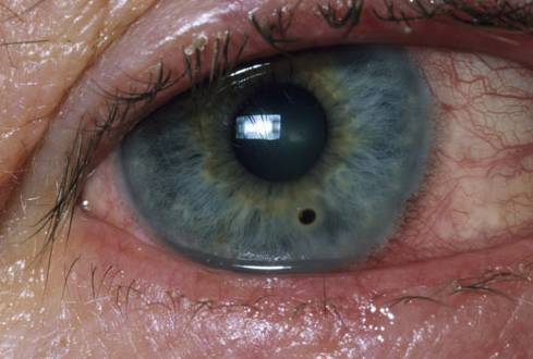 这15种常见眼科病,你了解的有哪些?