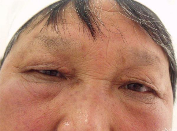 5种皮肤病都是糖尿病引起,后果很严重