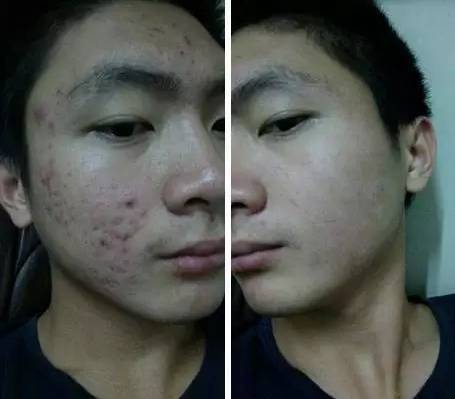 高中满脸痘痘的男孩子,用了惠惠老师的产品,27天祛痘成功!