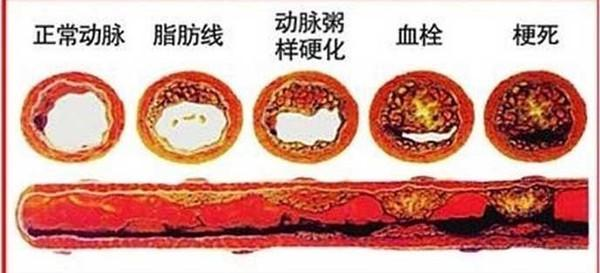 身体各项器官老化了,才导致人也变老,而老化最严重的当属血管.