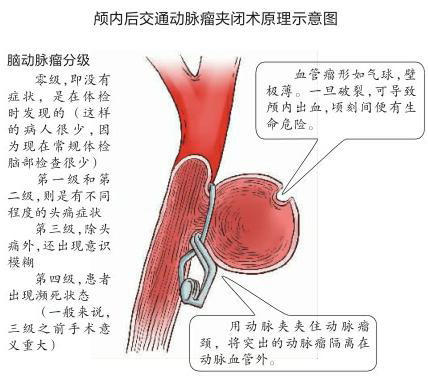 李铁红 偏爱中青年人的中风 蛛网膜下腔出血 健康频道 手机搜狐