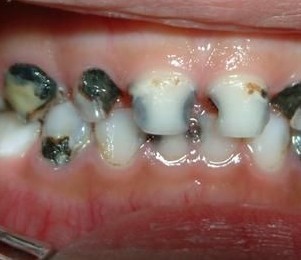 很多人牙根部会出现发黑的情况,当遇到这样的情况时大家都会非常的