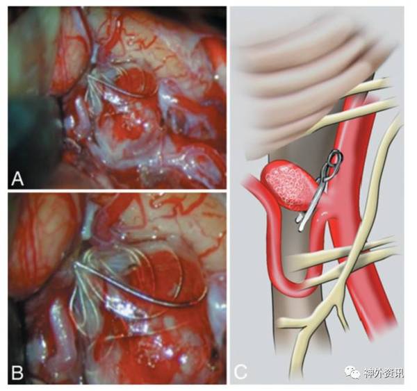 【天新福-神经介入专栏】| 开颅夹闭弹簧圈栓塞