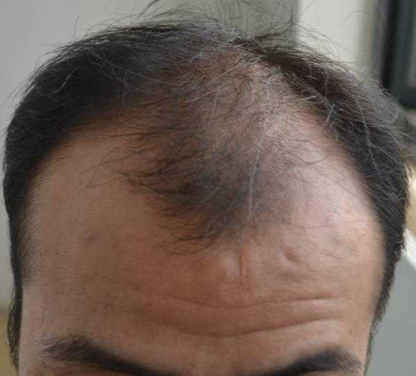 图为陈先生生发前的照片 可以清楚看见头顶中央只剩下一小撮头发