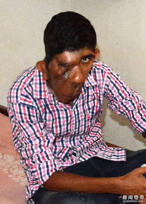 16岁少年患怪病,脸部一半正常一半似"融化"!