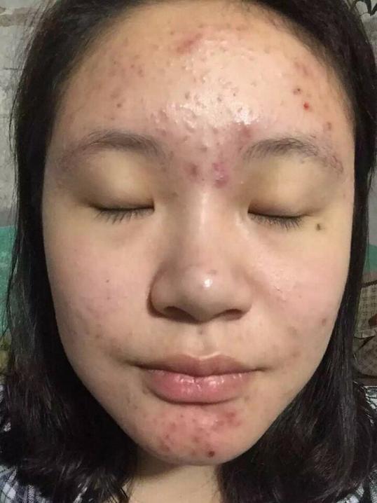 大家认为是"杂草"的中药,敷三四天,痘痘全消失