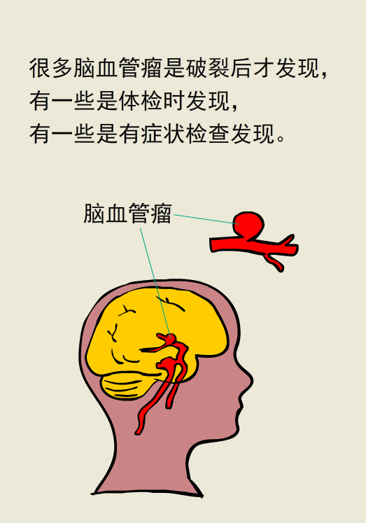 过了四十,女性要警惕脑血管瘤