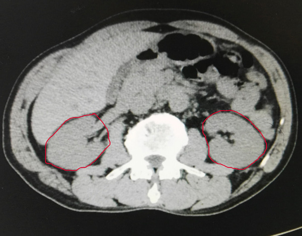 (红圈内为李先生肾脏影像 李先生双肾结石十分复杂,加之慢性感染对