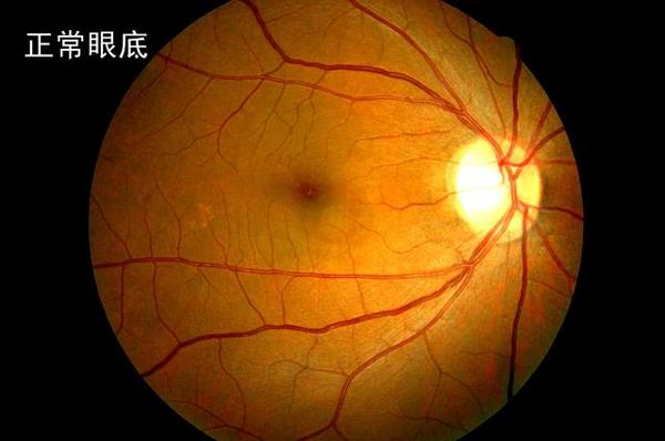 图2. 正常人眼底图