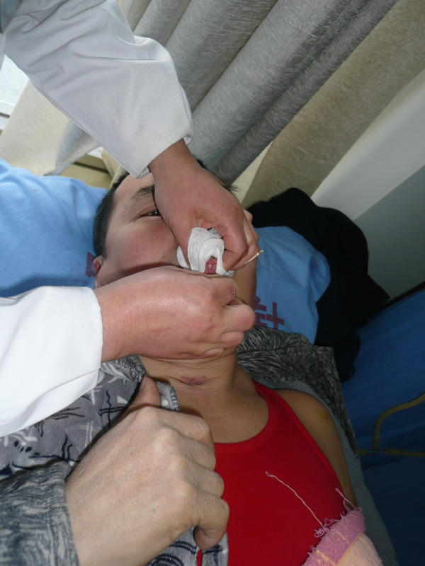 三针医院舌诊针刺特色疗法