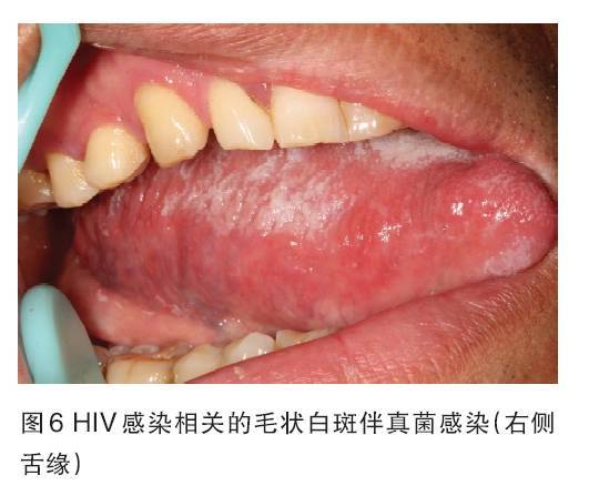 Aids患者和hiv携带者很多存在口腔病损 你能发现它们么 健康频道 手机搜狐