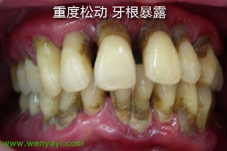 导致牙齿牙齿受力过度,使牙根周围组织改变,牙齿过度松动