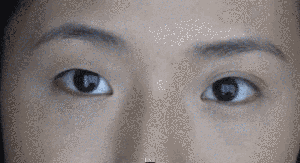 眼皮一单一双,该怎么做双眼皮手术