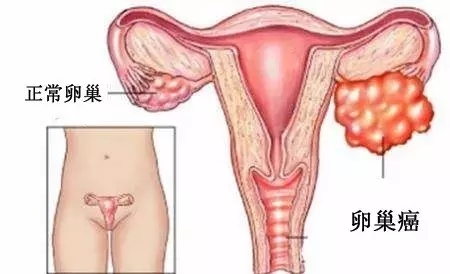 老是腹胀 当心是癌 卵巢癌常见的6个症状 健康频道 手机搜狐