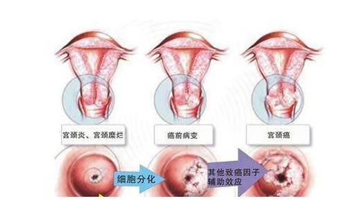 阴道炎是女性生殖系统的常见疾病之一,在发病的过程中伴有阴道黏膜的