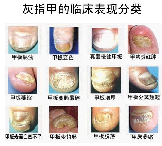 华军皮肤专家 灰指甲治愈后再次复发的原因解读 健康频道 手机搜狐